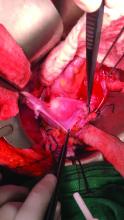 Figure D: Transplanted uterus immediately following graft reperfusion.